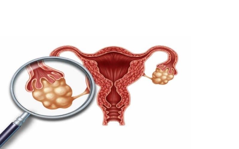 سندروم تخمدان پلی کیستیک (PCOS) و روش های درمان
