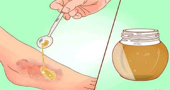 عسل طبیعی برای زخم ؛ استفاده از عسل طبیعی برای بهبود زخم