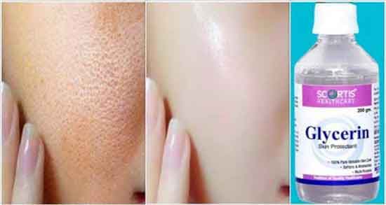 عوارض گلیسیرین ؛ عوارض مصرف گلیسیرین و گلاب برای چاقی صورت