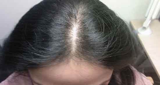 معجزه آب پیاز قرمز برای رشد مو ؛ افزایش رشد مو با استفاده از آب پیاز قرمز