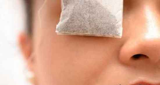 چای کیسه ای برای گل مژه ؛ درمان خانگی گل مژه با استفاده از چای کیسه ای