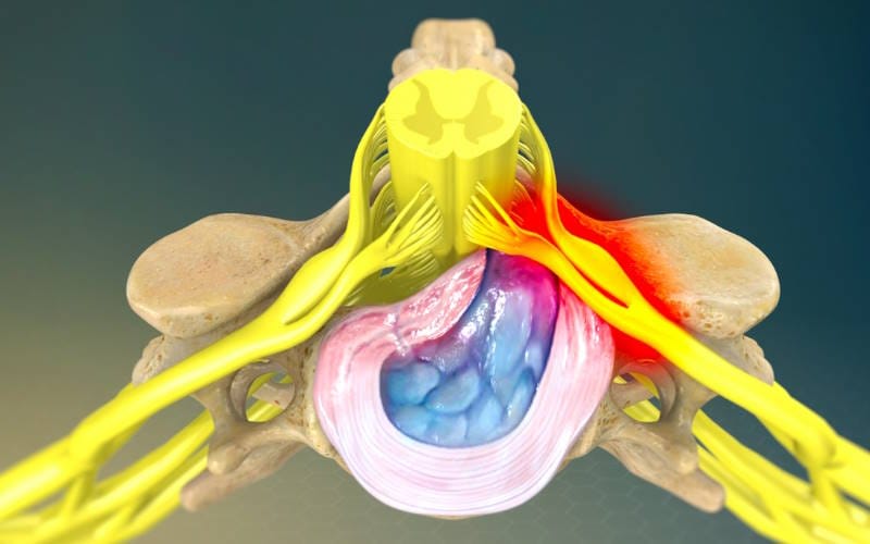 گودی کمر چیست؟ بررسی عوارض تا درمان و مشکلات گودی کمر چیست؟ بررسی عوارض تا درمان و مشکلات