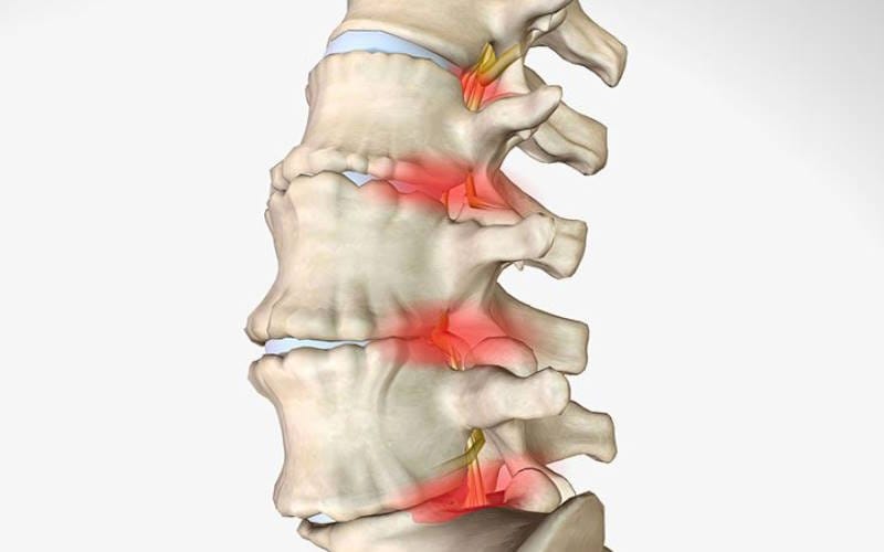 گودی کمر چیست؟ بررسی عوارض تا درمان و مشکلات گودی کمر چیست؟ بررسی عوارض تا درمان و مشکلات