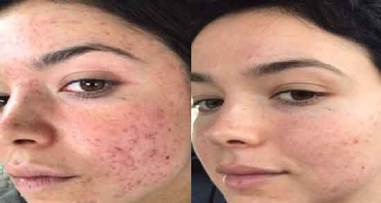 آب پیاز برای جوش و از بین بردن جوش های صورت با ماسک آب پیاز آب پیاز برای جوش ؛ از بین بردن جوش های صورت با ماسک آب پیاز