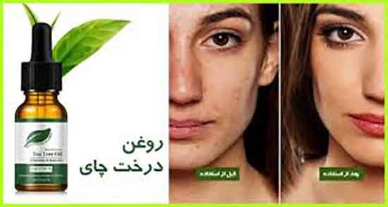 روغن درخت چای و جای جوش ؛ روغن درخت چای برای جای جوش صورت