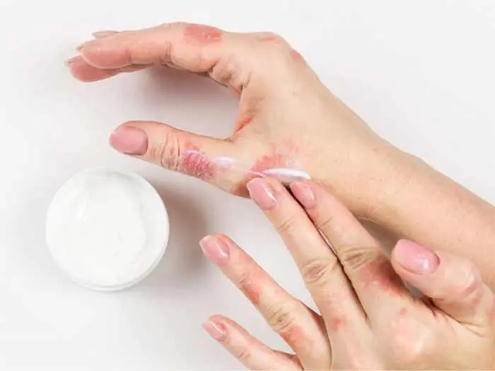 پماد بتامتازون برای چیست؟ موارد استفاده، عوارض و نحوه مصرف پماد بتامتازون برای چیست؟ موارد استفاده، عوارض و نحوه مصرف