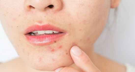 ادرار انسان برای جوش صورت و از بین بردن جوش و آکنه پوست با ادرار انسان ادرار انسان برای جوش صورت ؛ از بین بردن جوش و آکنه پوست با ادرار انسان