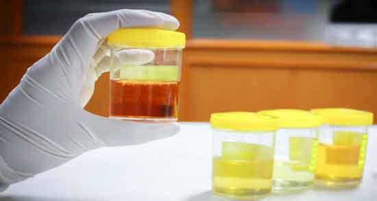 خواص ادرار انسان برای زخم و ضد عفونی کردن زخم با ادرار انسان خواص ادرار انسان برای زخم ؛ ضد عفونی کردن زخم با ادرار انسان