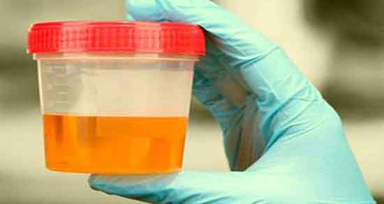 خواص ادرار انسان برای مو و جلوگیری از ریزش مو با استفاده از ادرار انسان خواص ادرار انسان برای مو ؛ جلوگیری از ریزش مو با استفاده از ادرار انسان