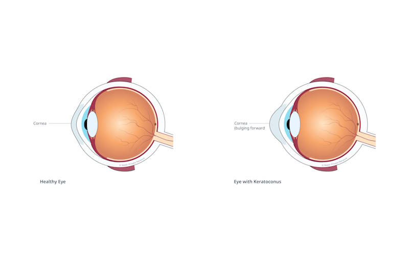 قوز قرنیه چیست؟ علل و درمان های جدید؛ پیشگیری و جراحی 1 Keratoconus قوز قرنیه چیست؟ علل و درمان های جدید؛ پیشگیری و جراحی