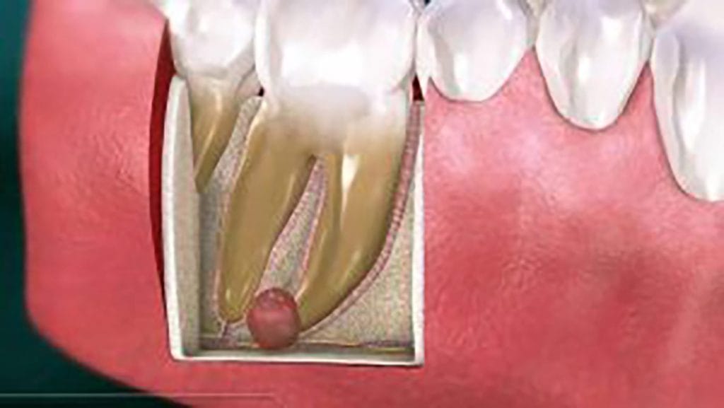 علائم و درمان کیست دندان علائم و درمان کیست دندان