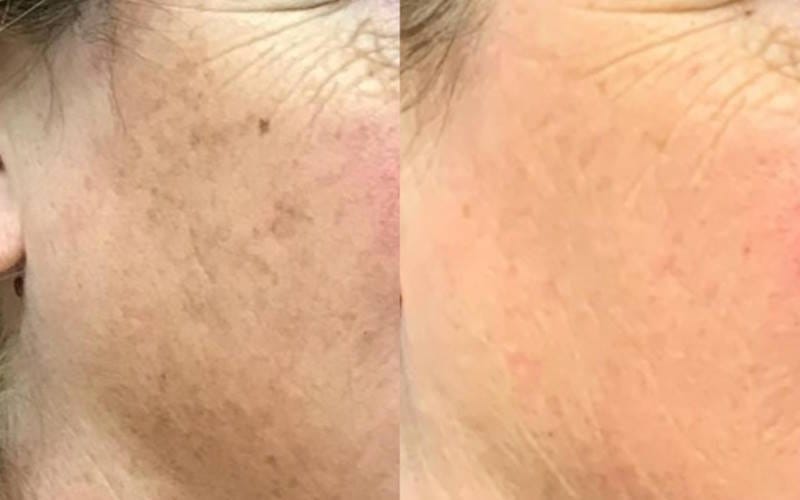 لکه های پیری و علل پیدایش آن ها؛ روش های درمان و پیشگیری لکه های پیری و علل پیدایش آن ها؛ روش های درمان و پیشگیری