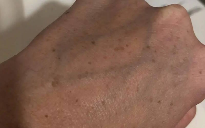 لکه های پیری و علل پیدایش آن ها؛ روش های درمان و پیشگیری لکه های پیری و علل پیدایش آن ها؛ روش های درمان و پیشگیری