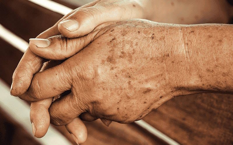 لکه های پیری و علل پیدایش آن ها؛ روش های درمان و پیشگیری لکه های پیری و علل پیدایش آن ها؛ روش های درمان و پیشگیری